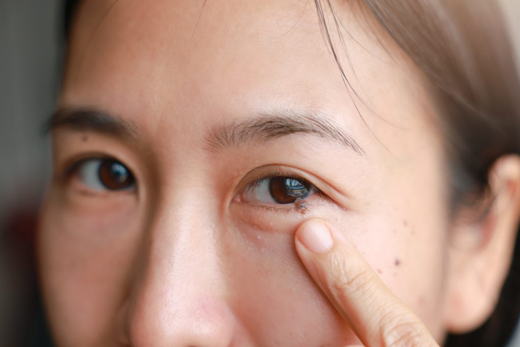 Eyelid Lumps, Swellings, and Tumors