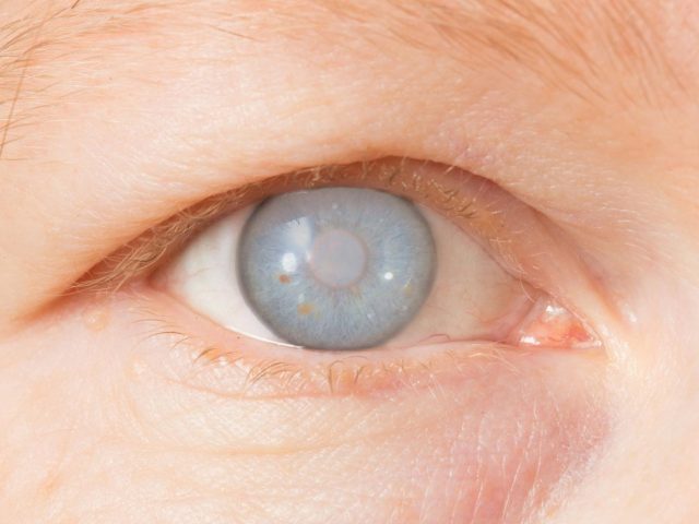 Cataract Surgery in Singapore