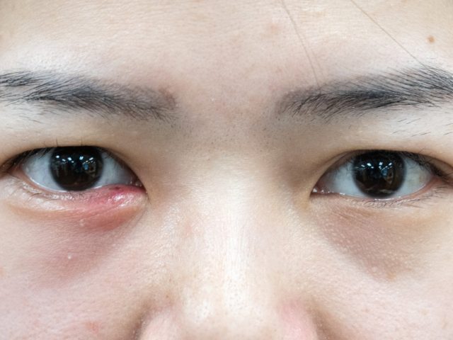 Blocked Tear Duct Treatment