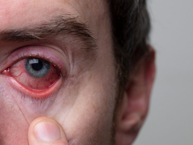 Orbital and Periorbital Cellulitis Treatment in Singapore