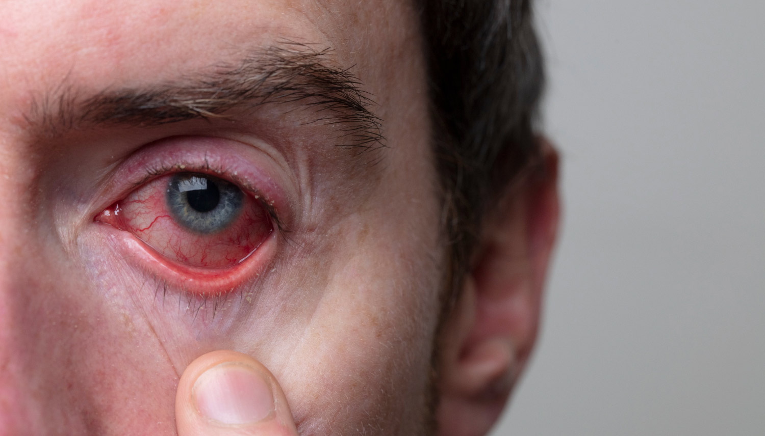 Orbital and Periorbital Cellulitis Treatment in Singapore