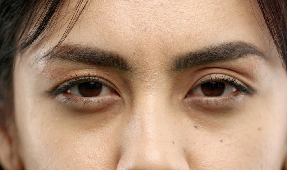 Ptosis Correction Singapore