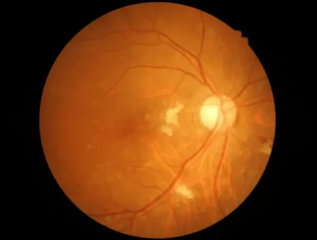 Causes of Glaucoma Symptoms