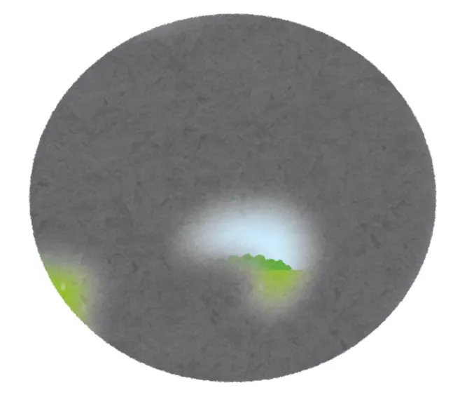 Glaucoma Tunnel Vision