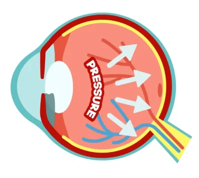What are Glaucoma Symptoms
