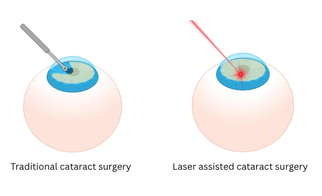 Bladeless Cataract Surgery with Dr Roy