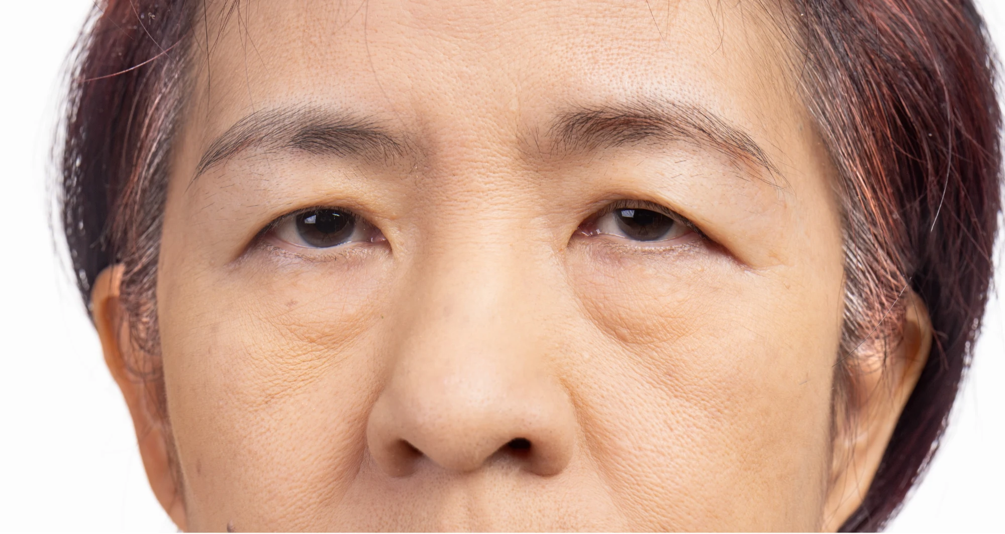Ptosis Surgery