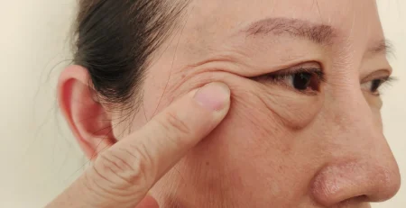 Eyelid Surgery in Singapore: Restoring Vision and Appearance