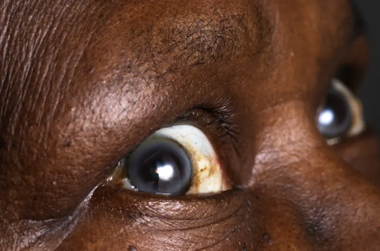 Close-up photograph of a human eye affected by a corneal ulcer. A distinct, hazy white or grayish opacity is visible on the transparent cornea over the iris, indicating tissue inflammation and ulceration. The surrounding sclera (white of the eye) shows significant redness and injected blood vessels (conjunctival injection).