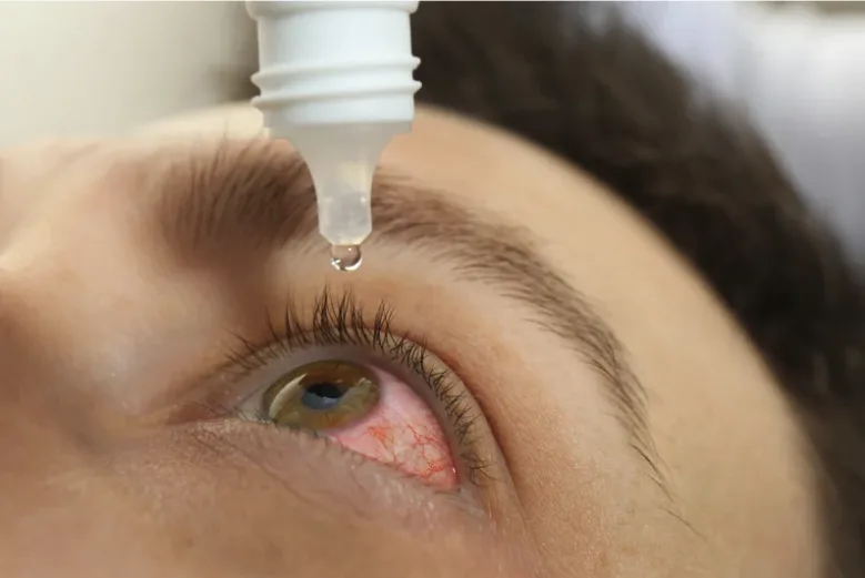 Close-up view of a person putting a therapeutic eye drop into their eye.