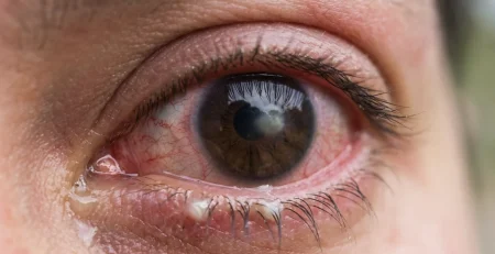 A close-up view of a human eye displaying a corneal ulcer, characterized by a white spot on the cornea and a red, inflamed sclera.
