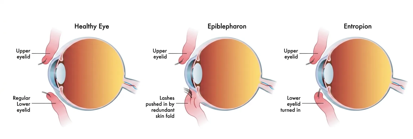 3D anatomical comparison of the lower eyelid in three states: a healthy eye with eyelashes pointing outward, an epiblepharon condition where a redundant horizontal skin fold pushes eyelashes inward while the lid margin remains properly positioned, and an entropion condition where the entire eyelid margin rolls inward, causing both margin and lashes to rub against the eye's surface.