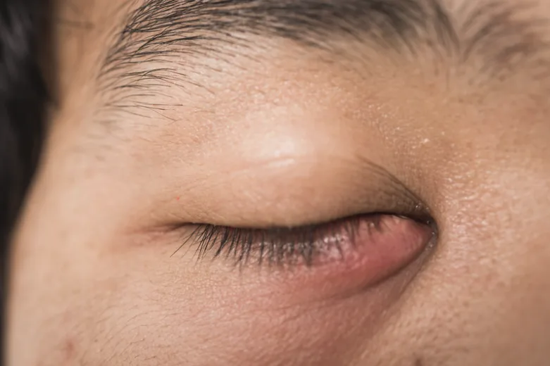 Asian man with a meibomian gland disease