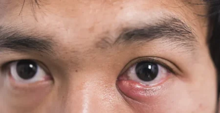 Asian man showing his eye with meibomian gland disease