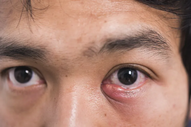 Asian man showing his eye with meibomian gland disease