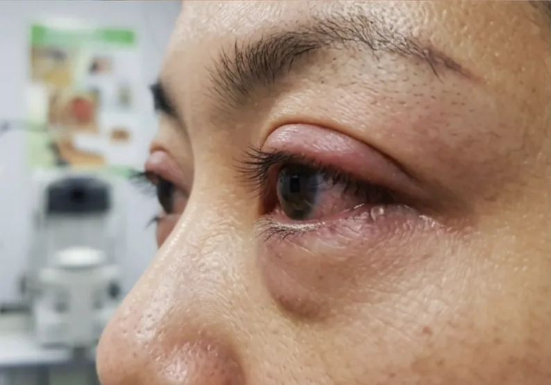 Side profile showing eyelid swelling and redness associated with thyroid eye disease.