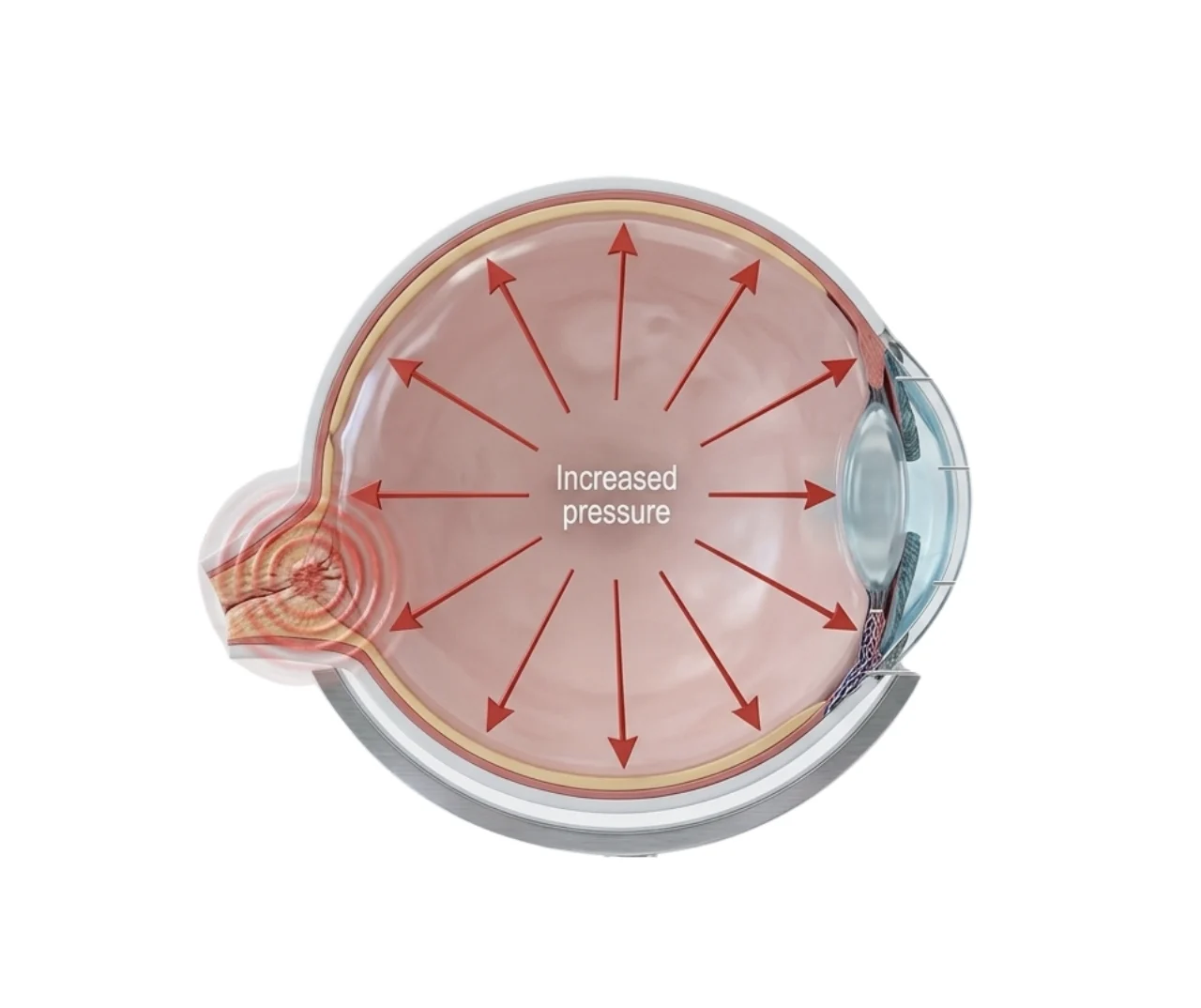 Diagram of increased intraocular pressure and optic nerve strain, key indicators evaluated during a glaucoma screening in Singapore.