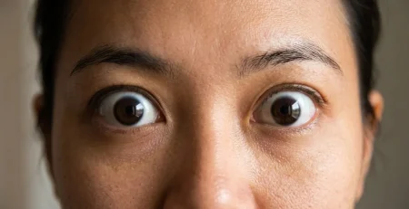 Front-facing close-up of an Asian woman displaying bilateral proptosis in Singapore.