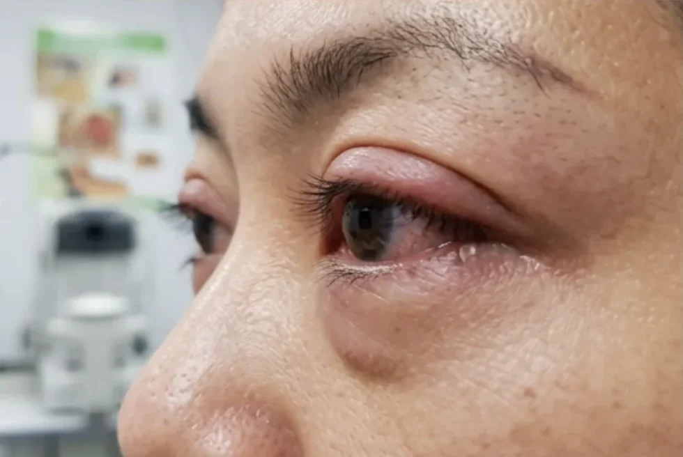 Close-up of an inflamed, swollen eye showing symptoms of proptosis in Singapore.